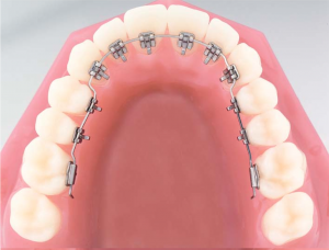 Treatment for Braces